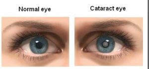 Grommen bouwer Londen Cataract - Causes | Symptoms | Surgery-Complications | Happy Eyesight